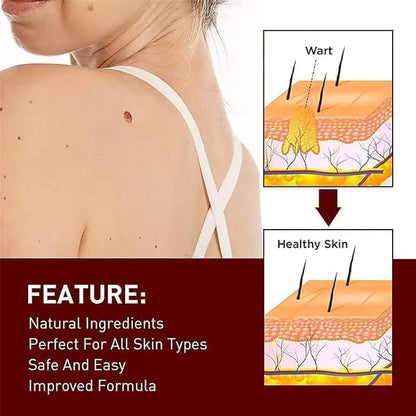 Liquid Wart Flat – Fast-Acting Topical Wart & Skin Tag Remover Beauty Hunt