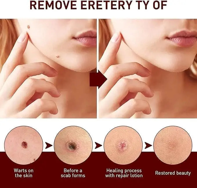 Liquid Wart Flat – Fast-Acting Topical Wart & Skin Tag Remover Beauty Hunt