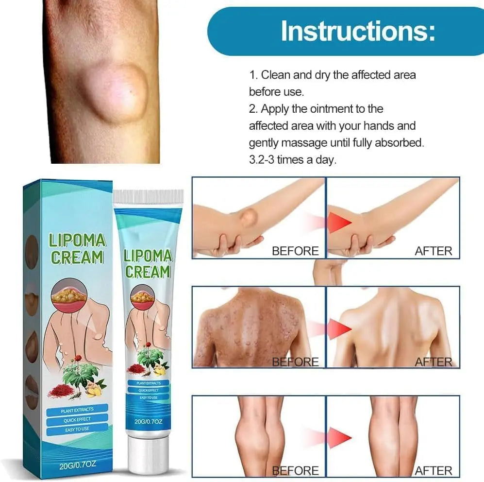 Lipoma Cyst Remover Cream – Topical Support for Reducing Lipomas & Skin Cysts Beauty Hunt