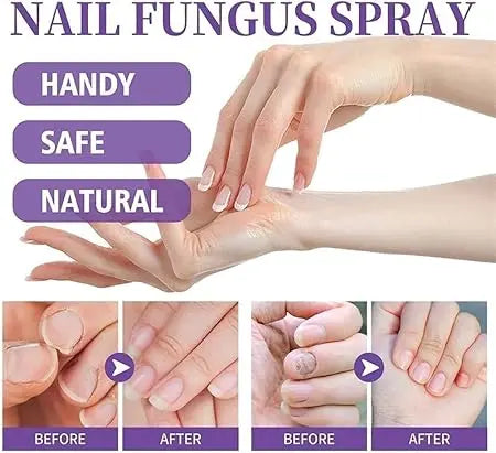 Advertisement for nail fungus spray showing hands with before and after effects.
