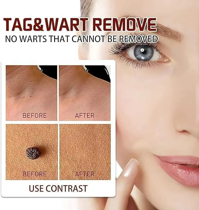 Liquid Wart Flat – Fast-Acting Topical Wart & Skin Tag Remover Beauty Hunt