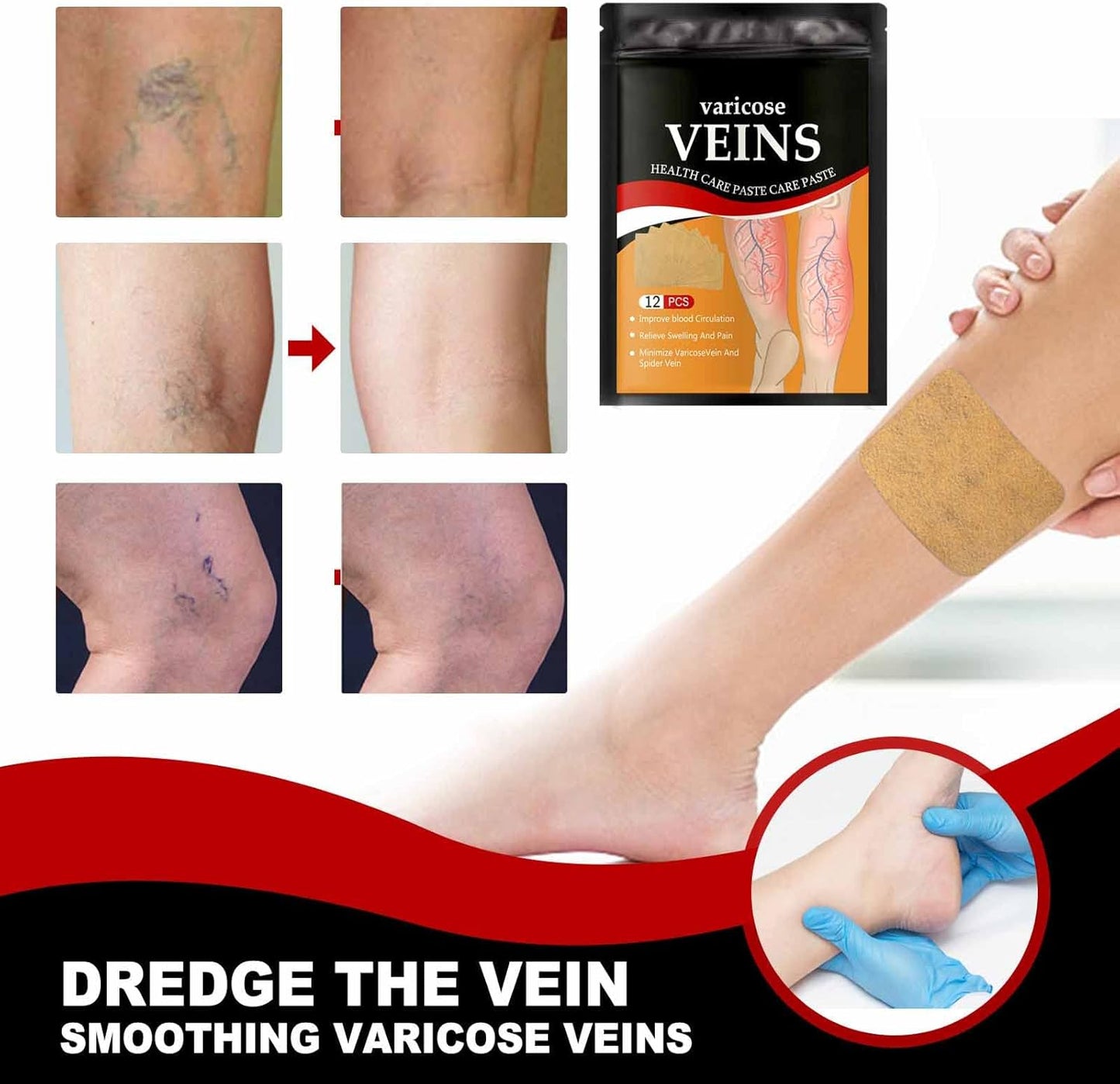 Hanel Varicose Veins Relief Patch – Natural Support for Leg Pain, Swelling & Spider Veins | Clinically Designed