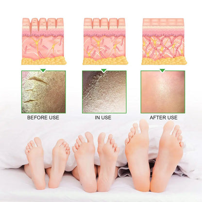 South Moon 42% Urea + 2% Salicylic Acid Cream - For Cracked Heels & Dry Skin Beauty Hunt