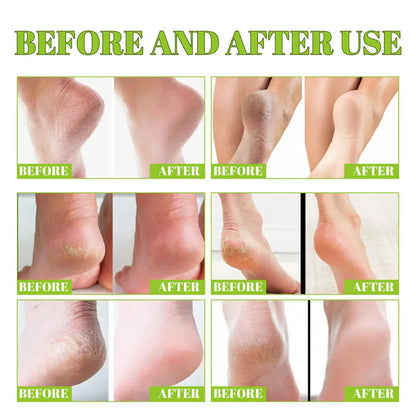 South Moon 42% Urea + 2% Salicylic Acid Cream - For Cracked Heels & Dry Skin Beauty Hunt