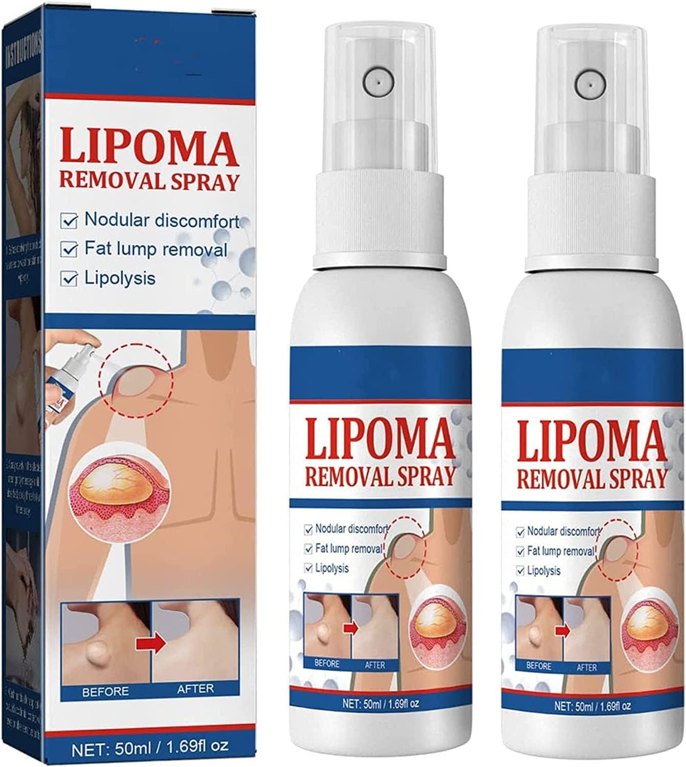 South Moon Lipoma Removal Oil Spray - Natural Fatty Lump & Tumor Dissolving Treatment (50ml)