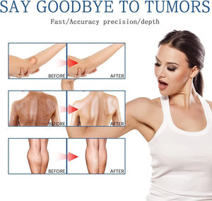 South Moon Lipoma Removal Oil Spray - Natural Fatty Lump & Tumor Dissolving Treatment (50ml)